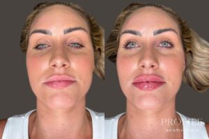 Lip Filler Before & After