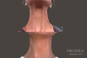 Neck Band Treatment (Nefertiti Neck Lift)