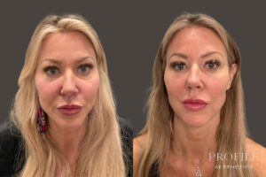 Sculptra Before & After