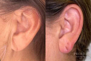 Earlobe Filler Before & After