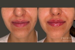 Lip Filler Before & After