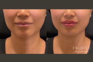 Lip Filler Before & After