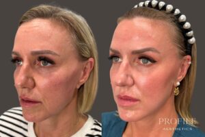 Sculptra Before and After