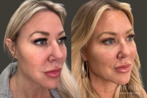 Sculptra Before and After