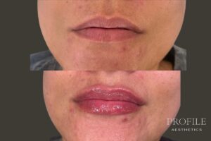 Lip Filler Before & After