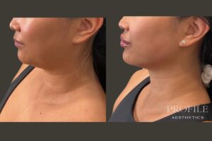 Lip and Jawline Filler Before & After