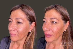 Liquid Facelift Using Dermal Filler