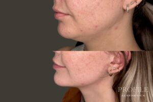 Kybella Fat Dissolve Before & After