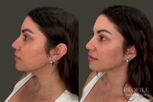 Liquid Facelift Using Dermal Filler