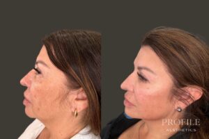 Liquid Facelift Using Dermal Fillers