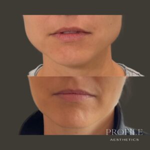 Facial Slimming Masseter Treatment