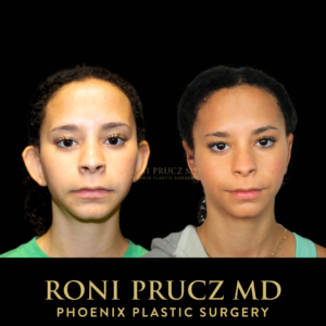 Otoplasty Front 300x300