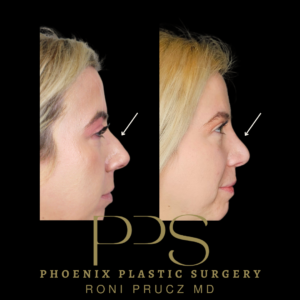 Rhinoplasty Lateral View 300x300